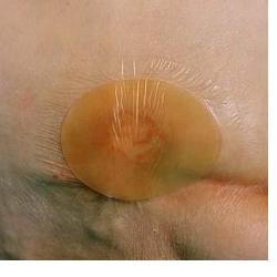 MEDICAZIONE IDROCOLLOIDALE TEGADERM HYDROCOLLOID THIN QUADRATA SENZA BORDO 10X10CM 5 PEZZI - Farmacia-flash.it